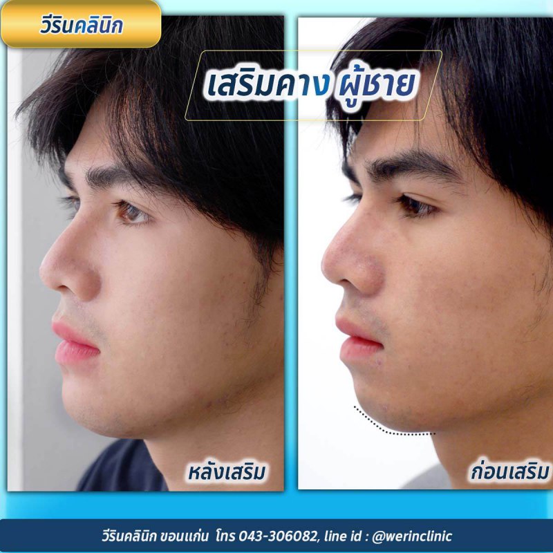 รีวิวคางผู้ชาย