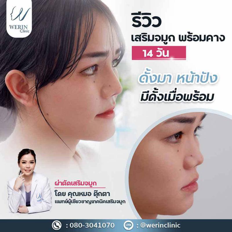 รีวิวจมูกคาง1web