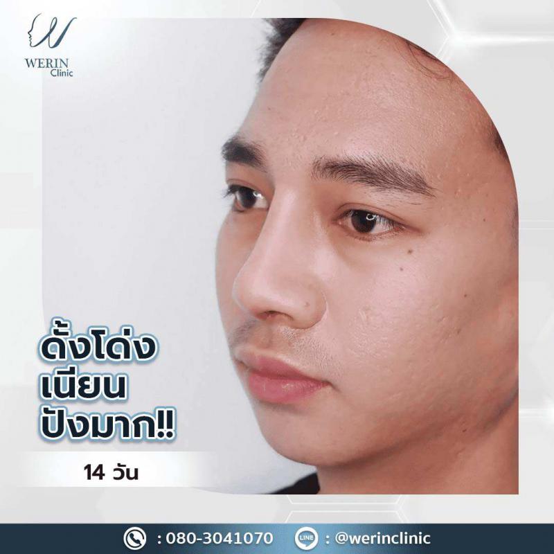 รีวิวจมูกผช28web