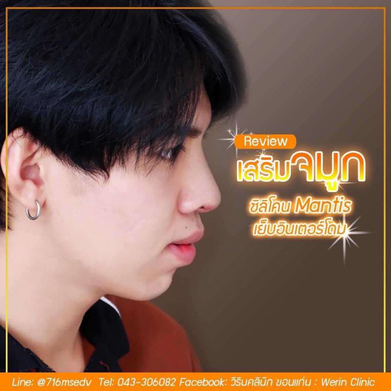 รีวิวจมูกผู้ชาย_๒๑๐๘๑๑_12