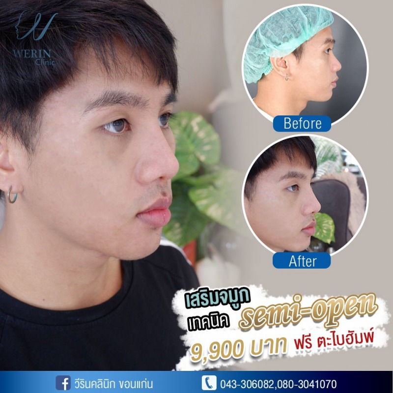 รีวิวจมูกผู้ชาย_๒๑๐๘๑๑_15