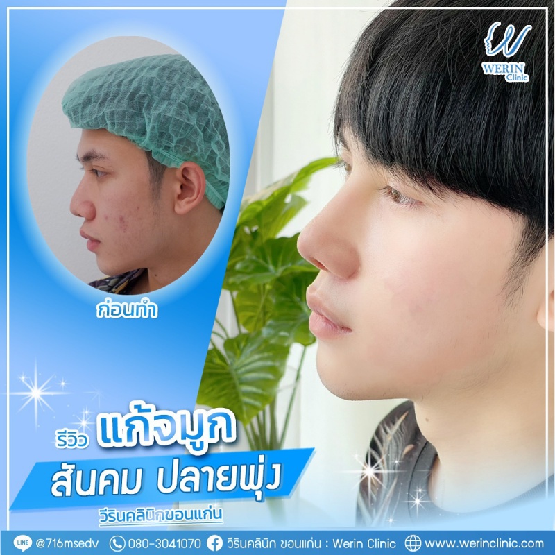 รีวิวจมูกผู้ชาย_๒๑๐๘๑๑_20