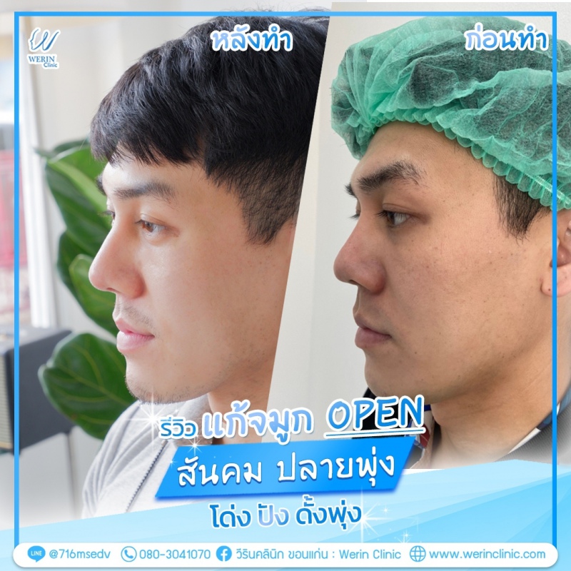 รีวิวจมูกผู้ชาย_๒๑๐๘๑๑_21