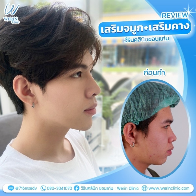 รีวิวจมูกผู้ชาย_๒๑๐๘๑๑_24