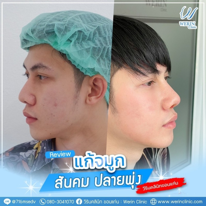 รีวิวจมูกผู้ชาย_๒๑๐๘๑๑_25