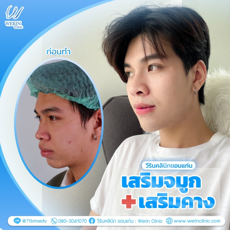 รีวิวจมูกผู้ชาย_๒๑๐๘๑๑_34