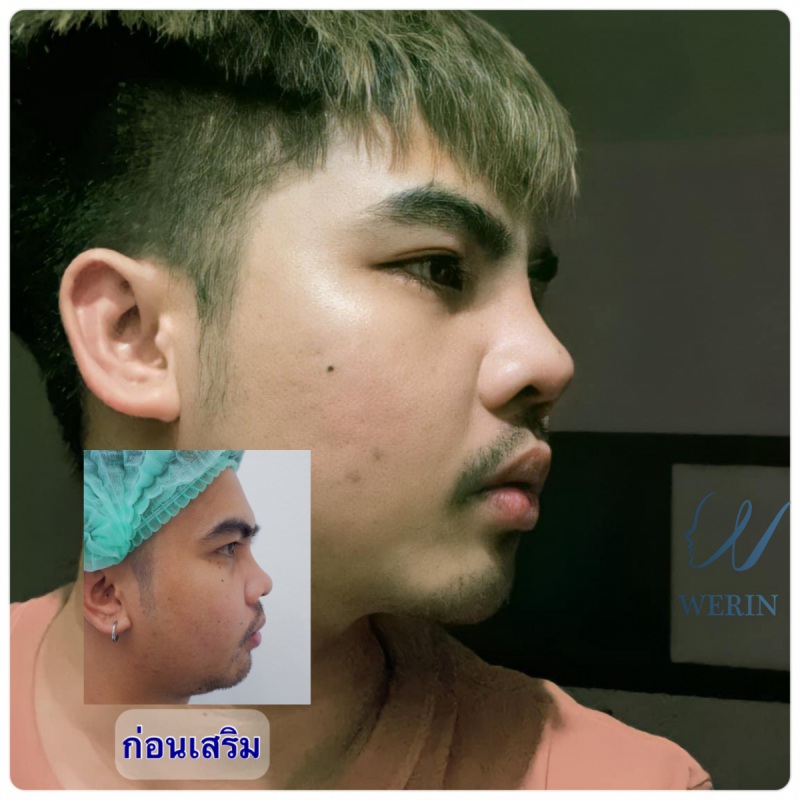 รีวิวจมูกผู้ชาย_๒๑๐๘๑๑_35