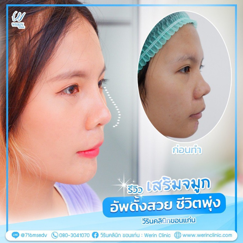 รีวิวจมูกผู้หญิง_๒๑๐๘๑๐_28