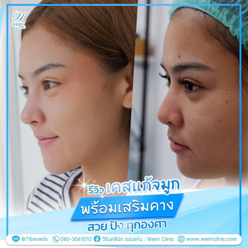 รีวิวจมูกผู้หญิง_๒๑๐๘๑๐_31