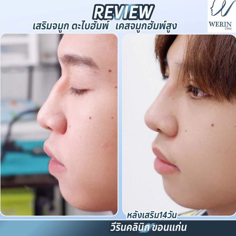 รีวิวจมูกฮัมภ์สูงweb